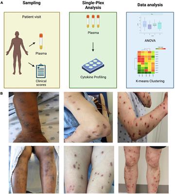 Frontiers Circulating Plasma IL 13 And Periostin Are Dysregulated